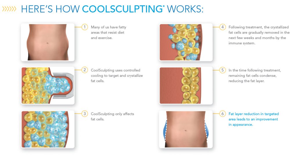 How Does CoolSculpting Works?