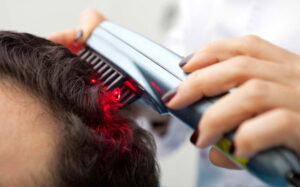 Laser hair biostimulation