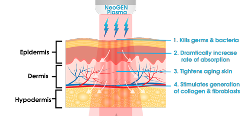 What makes NeoGen Plasma effective?