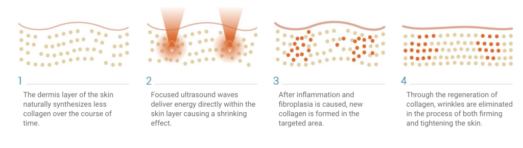 How does HIFU treatment works?