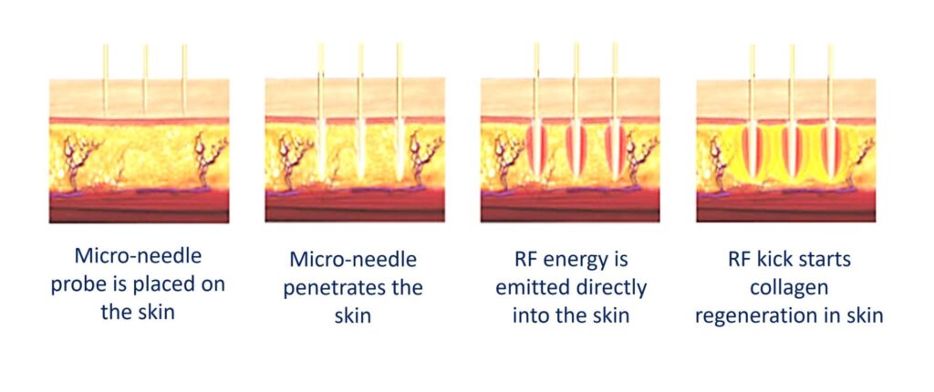 Sylfirm X is a minimally invasive treatment, it stimulates collagen production through microneedles releasing RF heat energy. This improves skin tone, refines pores, improve the appearance of fine line and wrinkles and improves the acne scars. Microneedling trigger skin repair and collagen production, at the same time, break down scar tissue.