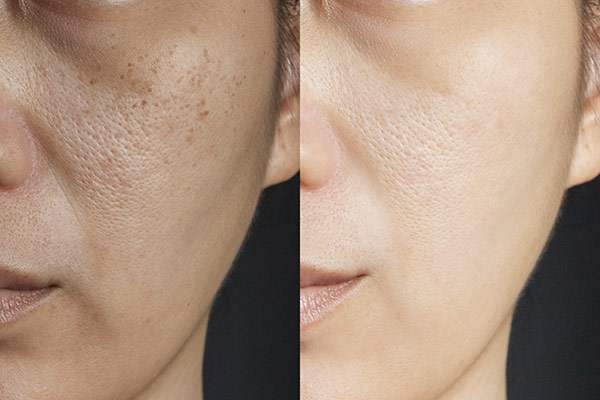 Laser Skin Rejuvenation